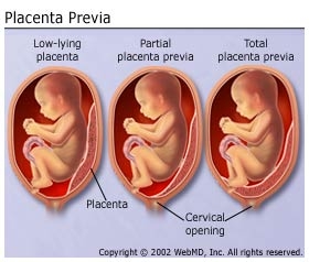 Tratament - placenta praevia